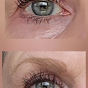 Eye lift